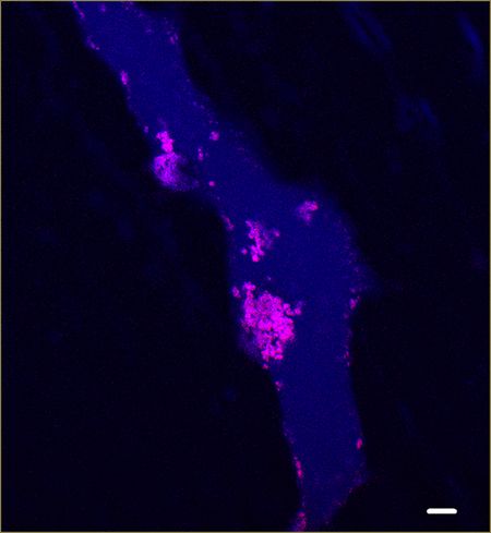 Humanes Blutgefäß mit atherosklerotischen Ablagerungen. C1q-ApoE Komplexe (pink) werden in den Ablagerungen detektiert. Quelle: Christine Skerka, Leibniz-HKI